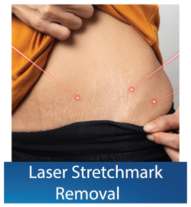 Best Laser Stretch mark removal clinic in Dubai
