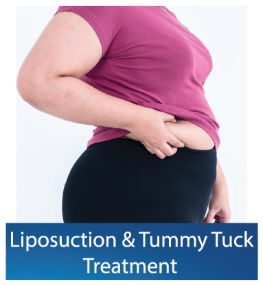 Liposuction-Tummy-Tuck treatment in Dubai