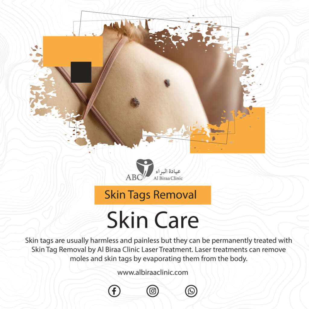 Laser Skin-Tags-Removal-Dubai